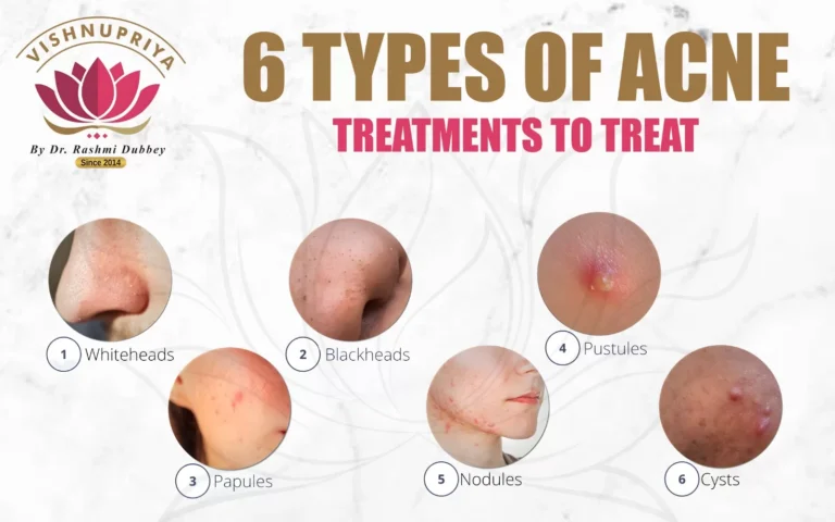 6-type-acne-treatement