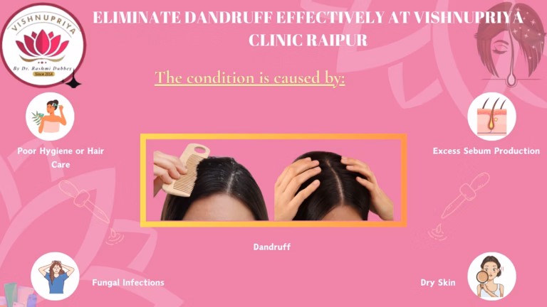 Eliminate Dandruff