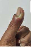  before treatment