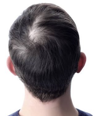 Oily Scalp Treatment before