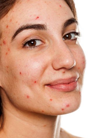 Acne Treatment before